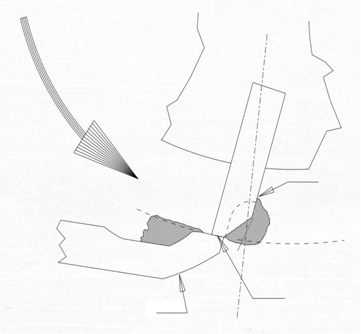 De achterslijphoek creëert een ruimte waar de lappasta blijft zitten. De slijppasta wordt geforceerd tussen de snijcilinder en het ondermes. De achterslijphoek creëert een ruimte waar de lappasta blijft zitten. De slijppasta wordt geforceerd tussen de snijcilinder en het ondermes.